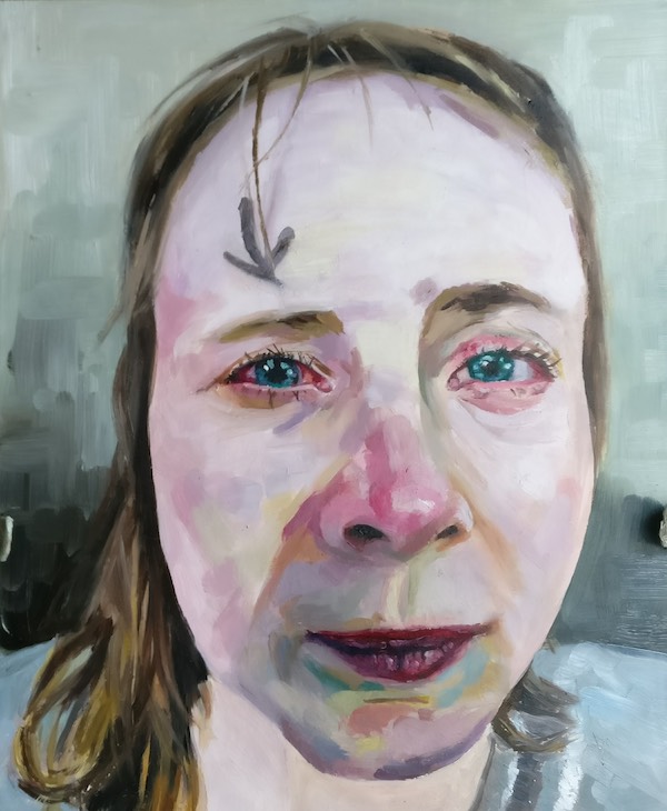 Glaucoma (2017)
